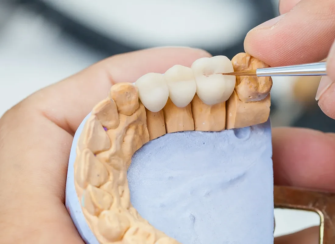 What is Dental Bridges