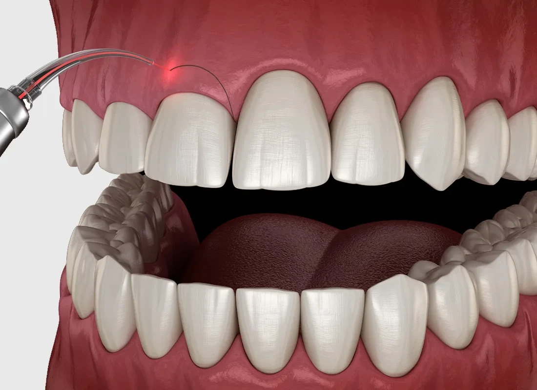 Gum Disease Treatment: Stages, Best Therapies, and How to Prevent Its Return