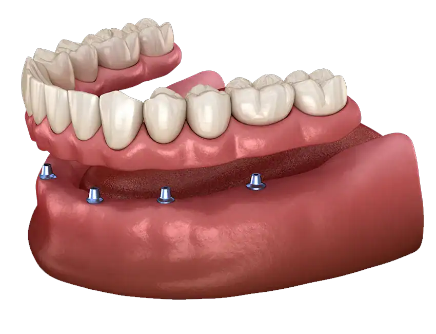 6 Major Benefits of Implant Supported Dentures Over Traditional Options