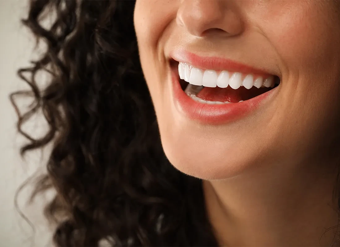 What is Veneers