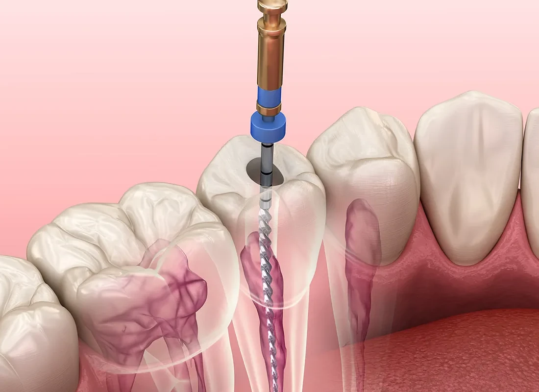 Tips To Prepare for a Root Canal
