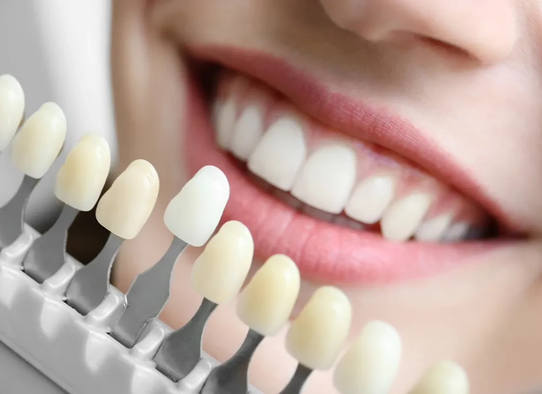Cosmetic Dentistry Procedures for Teeth Whitening