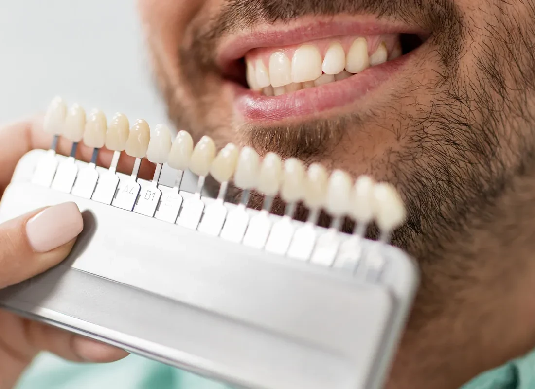Exploring the Different Teeth Whitening Options