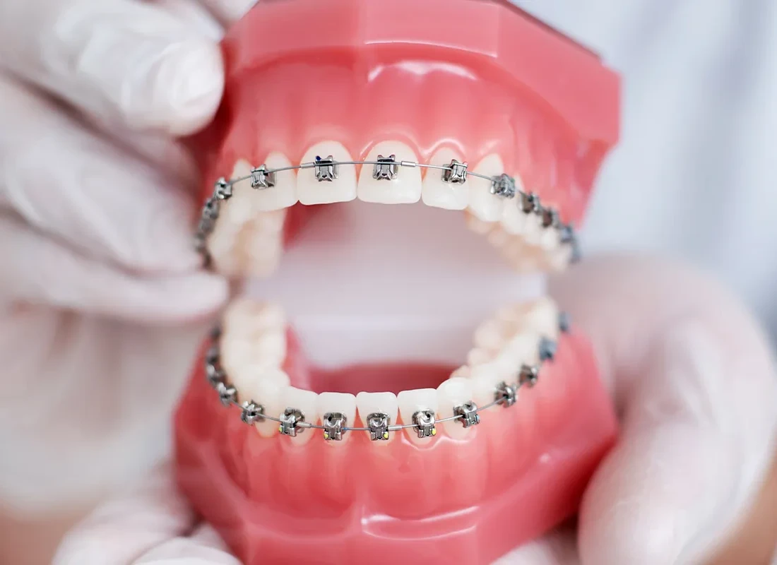 Orthodontics: Teeth-Straightening Options From a General Dentist