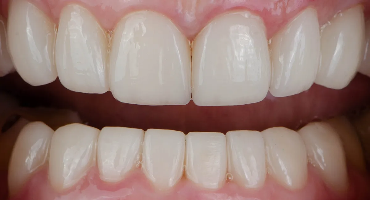 Smile makeover — after
