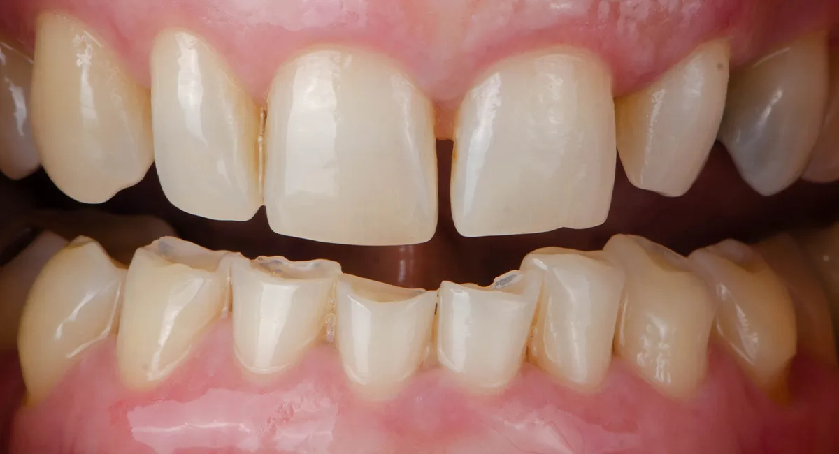 Smile makeover — before
