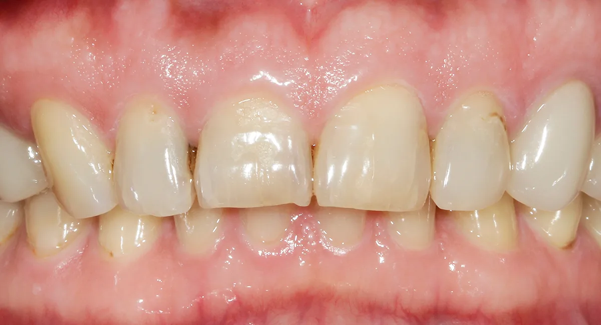 Cosmetic restoration — before