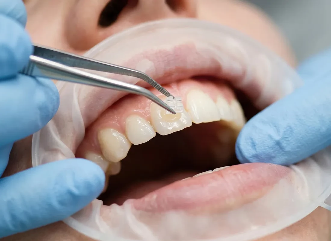 How a Cosmetic Dentist Uses Dental Bonding