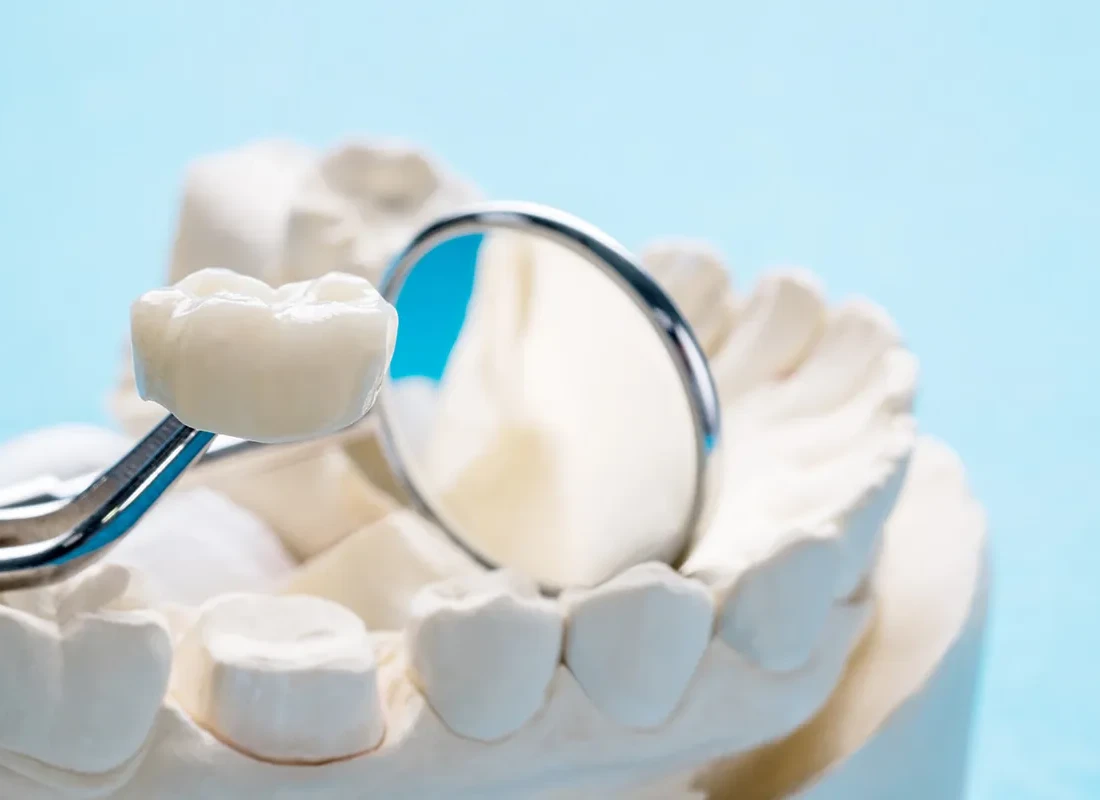 The Complete Guide to Dental Crowns: Types, Costs & Care