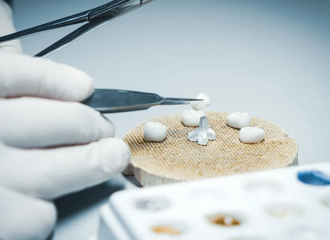 Dental Crowns vs. Dental Bridges