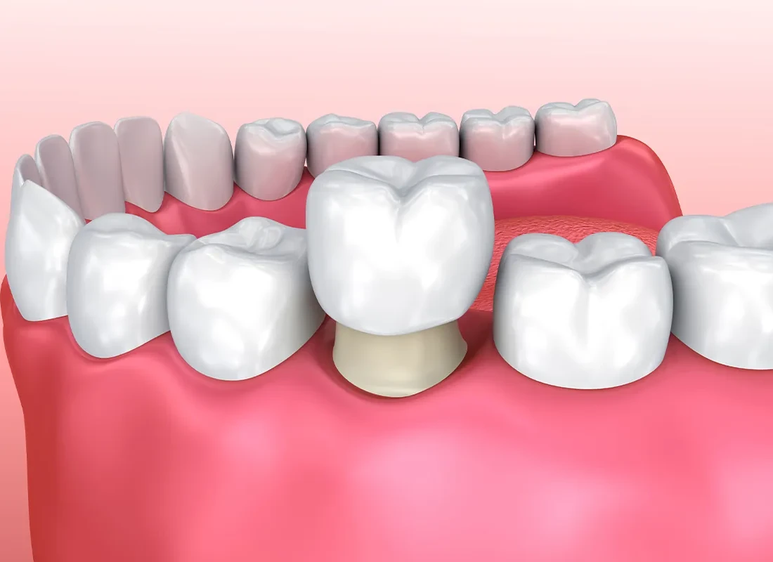 What to Know About the Dental Crown Process