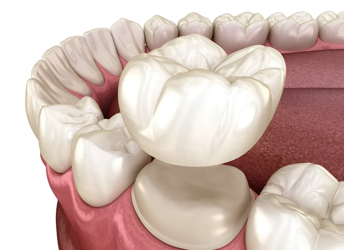 How Dental Crowns Are Bonded to a Tooth