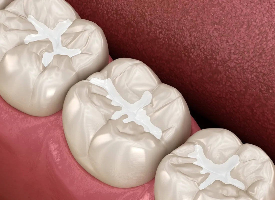 The Different Types of Dental Fillings