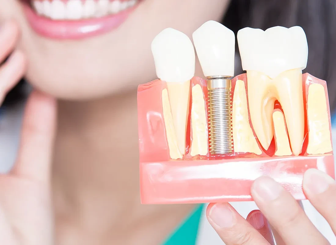 7 Things You Should Know Before Getting Dental Implants