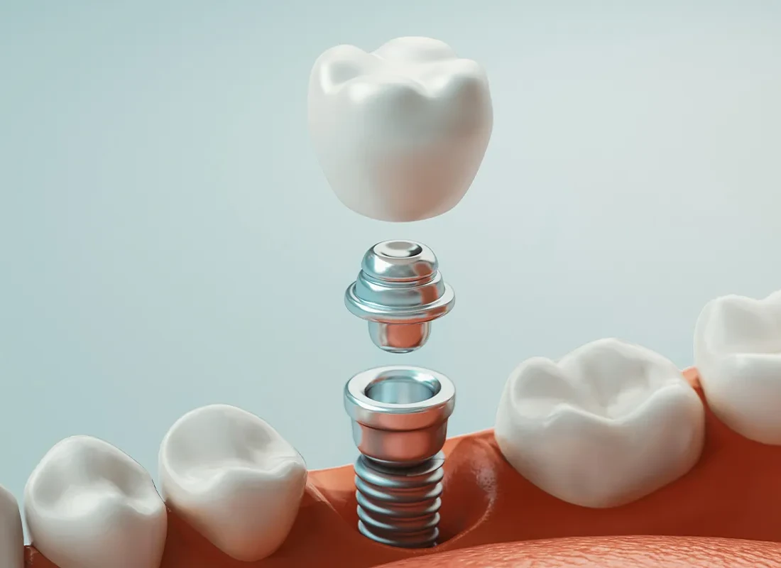 A Step by Step Guide to Dental Implants