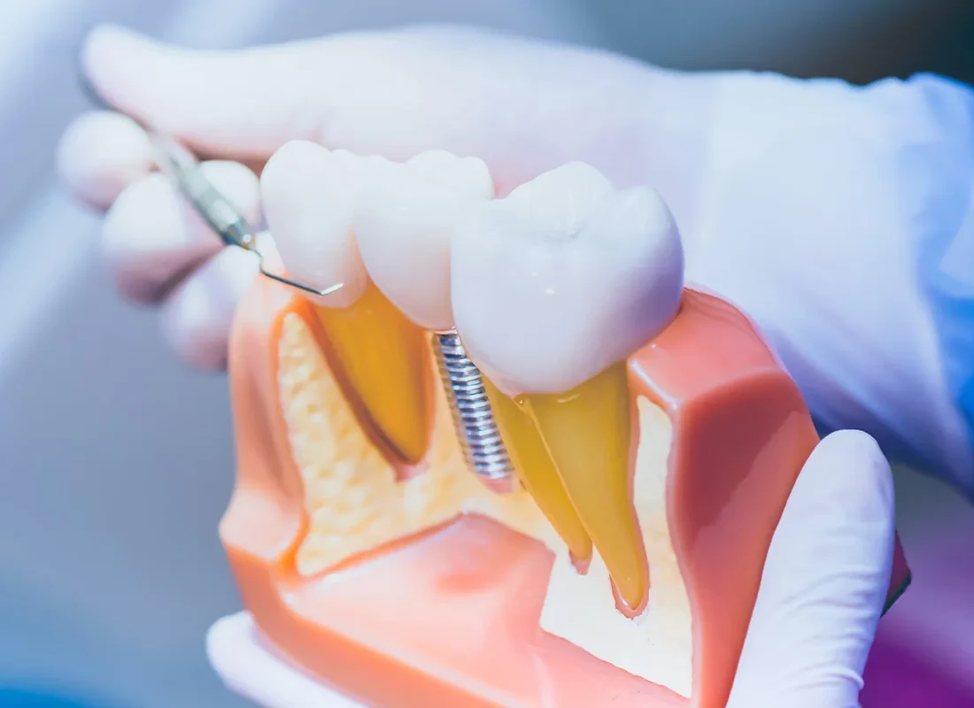 Understanding the Dental Implant Process