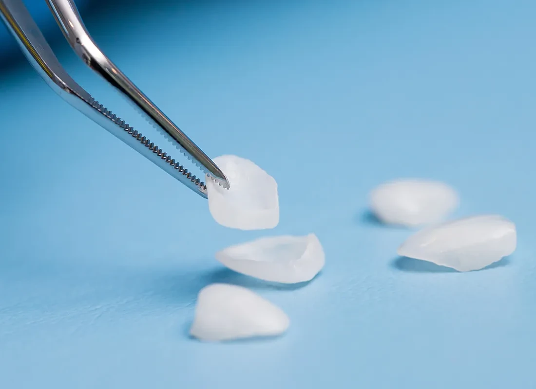 What’s the Difference Between Dental Bonding and Veneers?