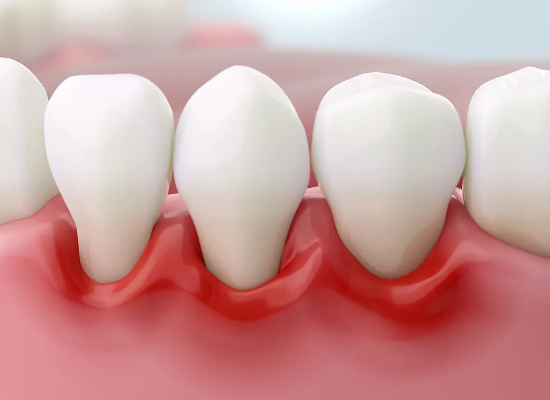 Fix a Gummy Smile With Cosmetic Dentistry