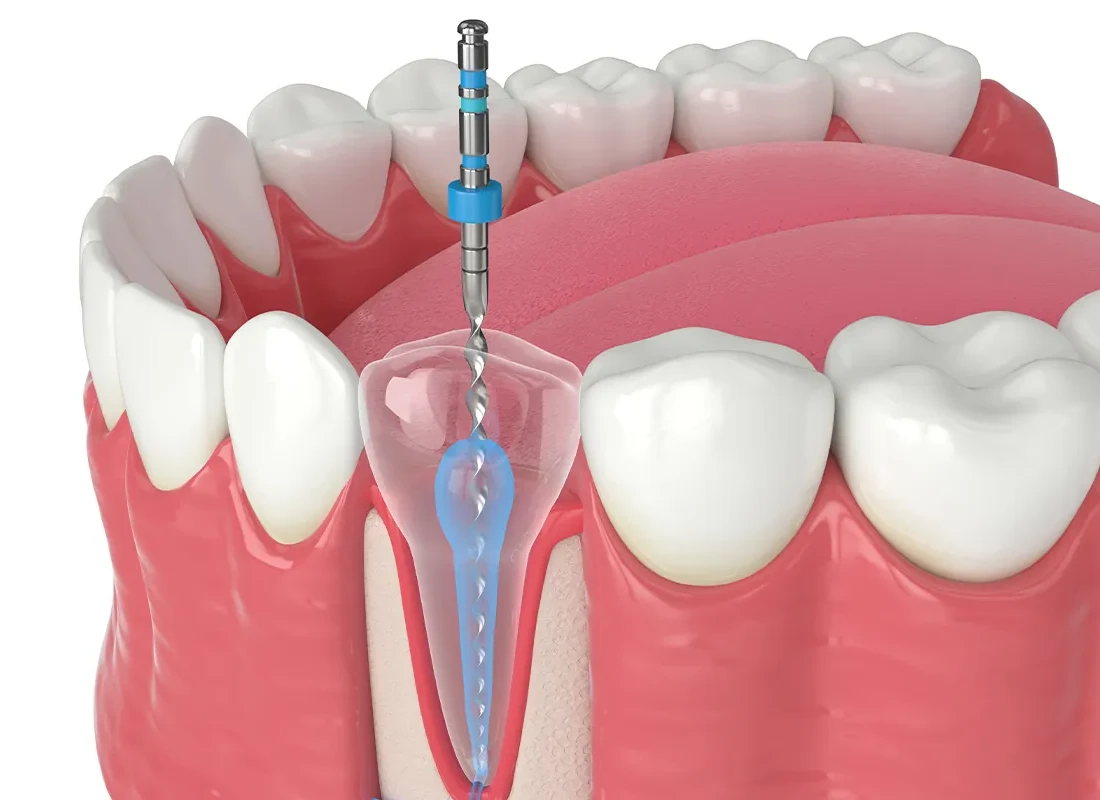 Why Are Root Canals Necessary?