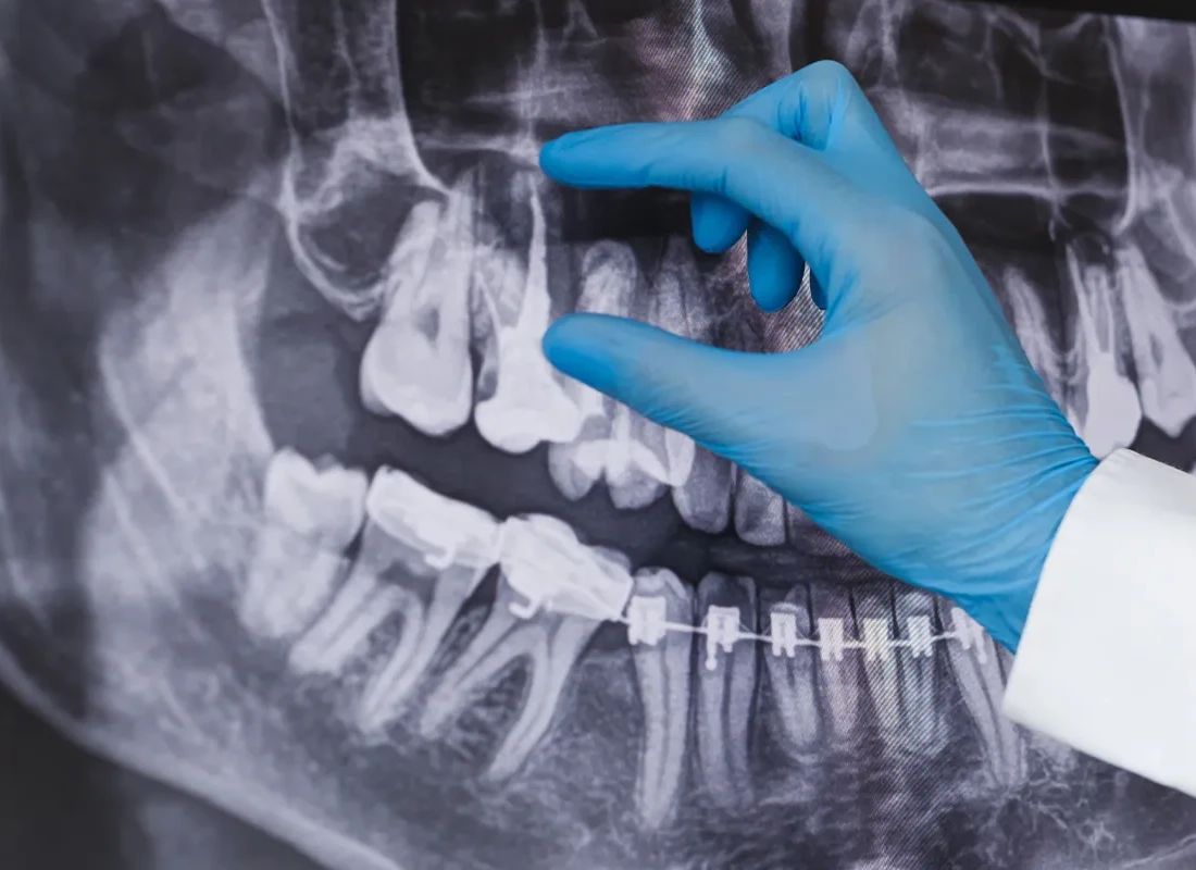 The Benefits of Root Canal Therapy