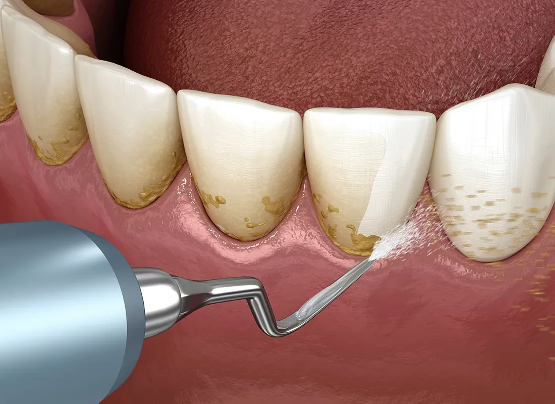 Teeth Cleanings as a Part of Routine Dental Care