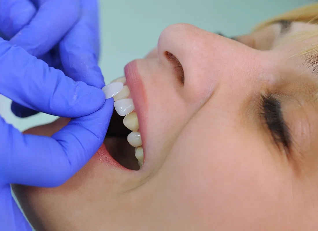 6 Questions to Ask Before Getting Dental Veneers